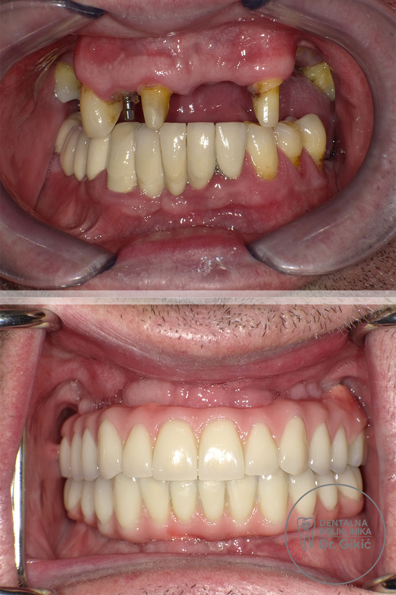 all-on-4-prije-poslije