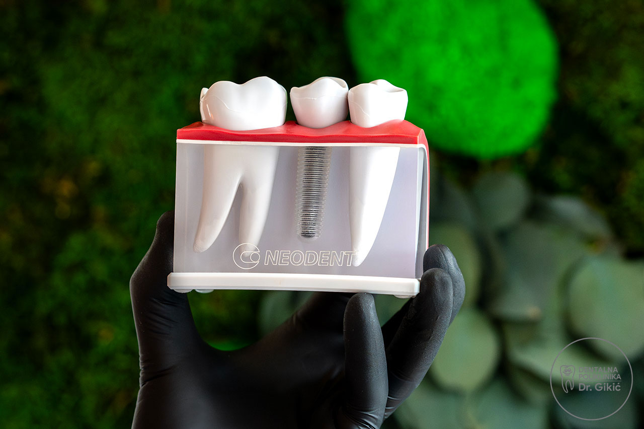 Kako se ugrađuju zubni implantati