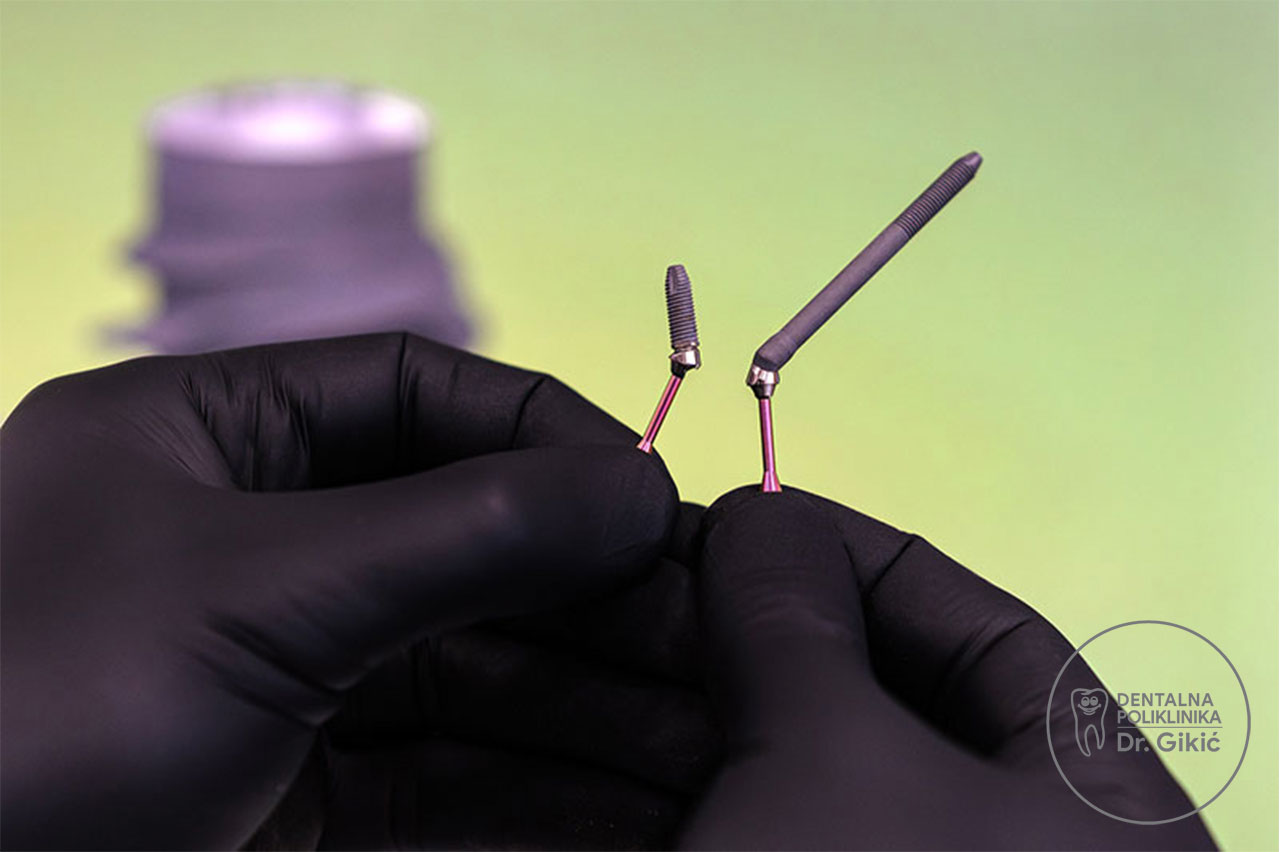 zygoma implantati